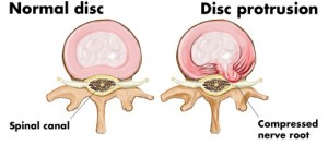 DISC BULGE